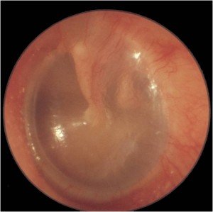 image of a clear healthy ear drum