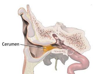 ear wax blocking an ear canal